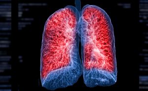 Pulmonary fibrosis