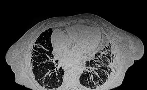 CT scans of pulmonary fibrosis